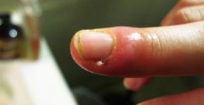 Нарыв на пальце возле ногтя: как лечить в домашних условиях?